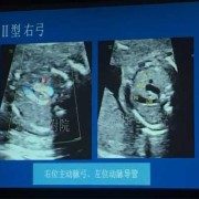 胎儿主动脉弓分支变异（胎儿主动脉弓分叉）