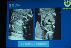 胎儿主动脉弓分支变异（胎儿主动脉弓分叉）
