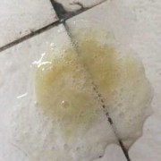 怀孕期间痰多怎么回事（怀孕后痰多怎么回事）