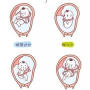 胎儿绕颈一圈怎样改善（胎儿脐带绕颈怎么办）