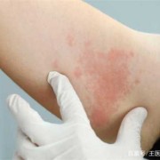 孕妇得带状疱疹对胎儿有什么影响,孕妇泡疹会影响胎儿吗