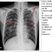 右肺上叶囊性灶是怎么回事,胎儿右肺囊性瘤影响不育吗