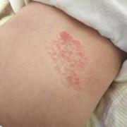 胎儿怎样预防血管瘤（宝宝出生时有血管瘤是什么原因）