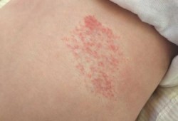 胎儿怎样预防血管瘤（宝宝出生时有血管瘤是什么原因）