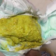 胎儿不排便（新生儿12小时没有大便这种情况正常的吗）