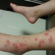 孕期紫癜初期症状（过敏性紫癜的初期症状是什么）