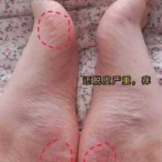 孕妇脚气对胎儿有影响吗（孕妇脚气对胎儿有影响吗图片）