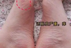 孕妇脚气对胎儿有影响吗（孕妇脚气对胎儿有影响吗图片）