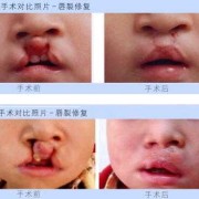 胎儿唇裂是什么原因造成的（兔唇的原因有哪些）