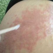 孕妇长湿疹怎么办,孕期湿疹严重会影响胎儿吗