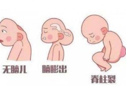 叶酸过多，会导致胎儿癫痫吗,胎儿羊癫疯的胎动特征
