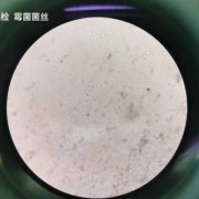 孕期有霉菌影响胎儿吗（孕期有霉菌影响胎儿吗）