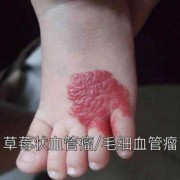 胎儿怎样预防血管瘤（宝宝出生时有血管瘤是什么原因）
