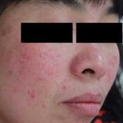 请问玫瑰痤疮怎么治疗,孕期玫瑰痤疮复发怎么办
