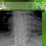 医院过错导致先天蝴蝶椎小孩出生要负多少责任,胎儿发现蝴蝶椎能治疗吗