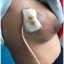 孕期乳腺（孕期乳腺脓肿怎么办）