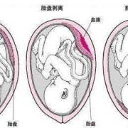胎盘位于子宫底及后壁，成熟度2级是什么意思,胎儿位于子宫后壁什么意思