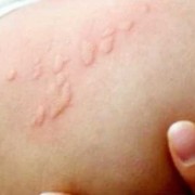 荨麻疹对胎儿（荨麻疹对胎儿有影响吗?）