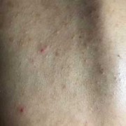 怎么去掉胸前和背后的痘痘和痘印,孕期胸口长痘痘怎么办