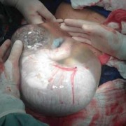 剖腹产宝宝吐羊水怎么办,胎儿吐羊水是怎么回事啊
