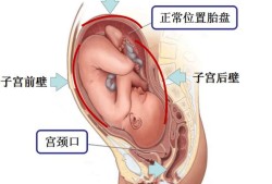 胎儿在后壁（胎儿在后壁）