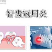 孕妇得了智齿冠周炎，该如何治疗,孕妇冠周炎怎么办