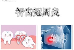 孕妇得了智齿冠周炎，该如何治疗,孕妇冠周炎怎么办