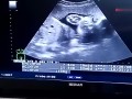 怀孕30周的胎儿图片（我的宝宝30周B超显示腿偏短怎么办）