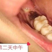 孕6周＋，智齿发炎疼，孕期可以拔牙吗,孕期可以拔牙吗
