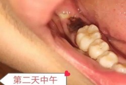 孕6周＋，智齿发炎疼，孕期可以拔牙吗,孕期可以拔牙吗