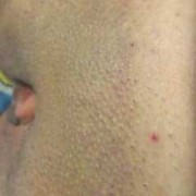 孕期阴毛处痒