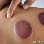 怀孕期间能拔罐吗（怀孕的时候还能够拔罐吗）