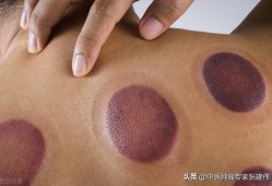 怀孕期间能拔罐吗（怀孕的时候还能够拔罐吗）