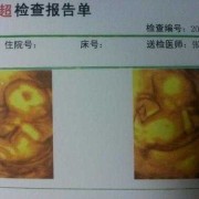 16周胎儿彩超（16周胎儿彩超图片）
