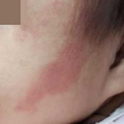 胎儿胎记是什么造成的（婴儿脸上有胎记是怎么回事）
