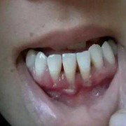 孕期牙龈萎缩（牙龈萎缩了还可以恢復吗）