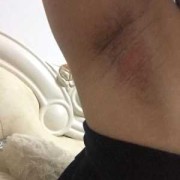 孕期腋下很痒（孕期腋下很痒起了一片红疹）