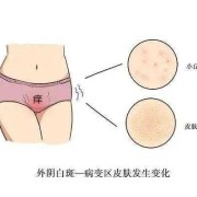 孕期大阴唇痒（孕期阴痒怎么办）