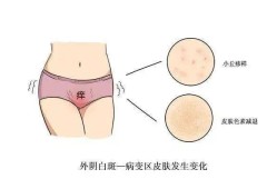 孕期大阴唇痒（孕期阴痒怎么办）