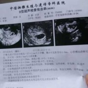 孕期卵巢囊肿怎么办,怀孕期间卵巢囊肿会变大吗