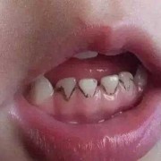 小孩子有龋齿会影响换牙吗,龋齿细菌对胎儿影响大吗
