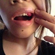 孕期牙龈出血是怎么回事,孕期牙龈肿了个肉坨怎么消肿