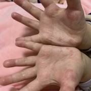 孕期手脚湿疹怎么办（孕期手脚湿疹怎么办啊）