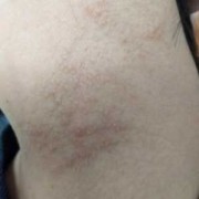 孕期为什么出湿疹（孕妇身上起疹子怎么回事）