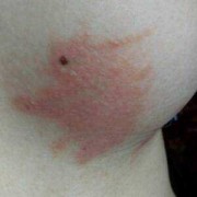 孕期乳房很痒（孕期乳房很痒挠破结痴反反复复）