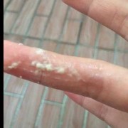 孕期阴部痒怎么办,孕期下体痒怎么办有豆腐渣