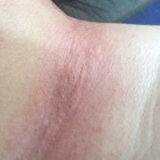 孕期脖子痒（孕期脖子痒怎么办）