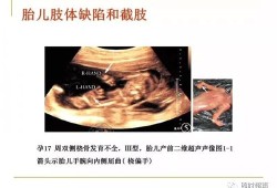 胎儿肢体小（胎儿肢体小于孕周）