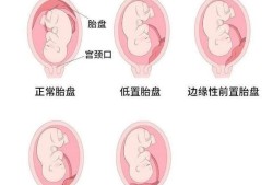 胎盘低对胎儿有影响吗（胎盘低对胎儿有影响吗孕六个月了）