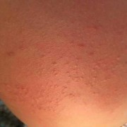 孕期皮肤瘙痒起红点点（怀孕9周，肚子上起红色疙瘩痒，请问有谁知道是什么原因吗）